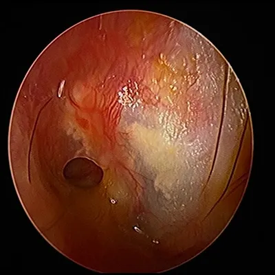 Ear surgery clinical details and operation setup at Elite Health Care Surat