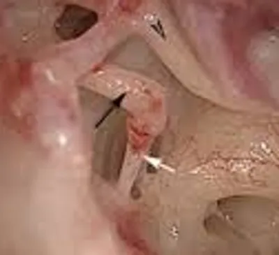 Ear surgery clinical details and operation setup at Elite Health Care Surat