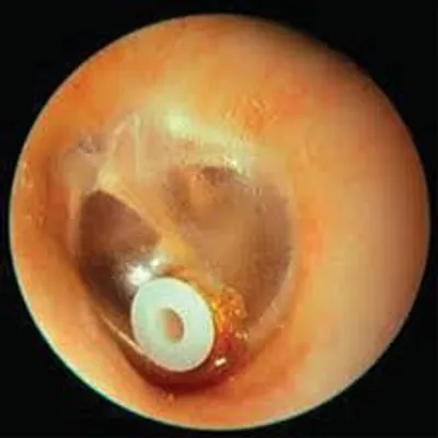 Ear surgery clinical details and operation setup at Elite Health Care Surat