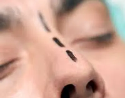 Nose surgery FESS setup at Elite Health Care Surat