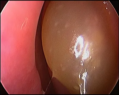 Nose surgery FESS setup at Elite Health Care Surat