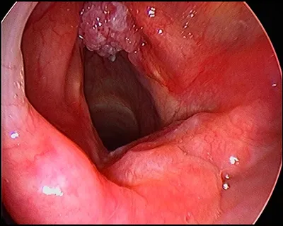 Throat surgery clinical details at Elite Health Care Surat