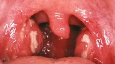 Throat surgery clinical details at Elite Health Care Surat