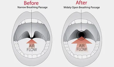 Throat surgery clinical details at Elite Health Care Surat