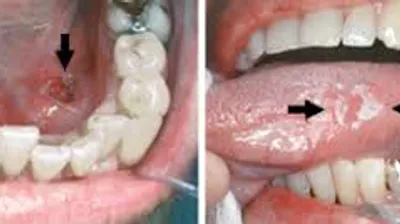 Throat surgery clinical details at Elite Health Care Surat
