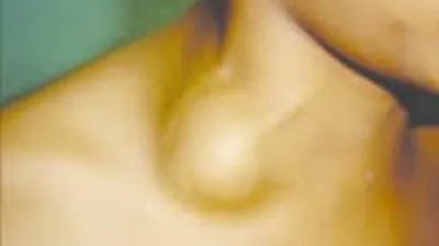 Throat surgery clinical details at Elite Health Care Surat